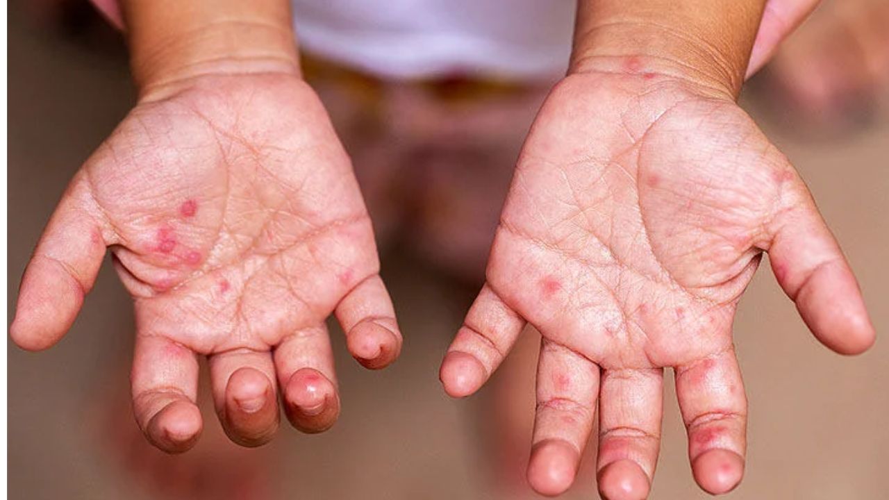 prevention of hand and foot infections