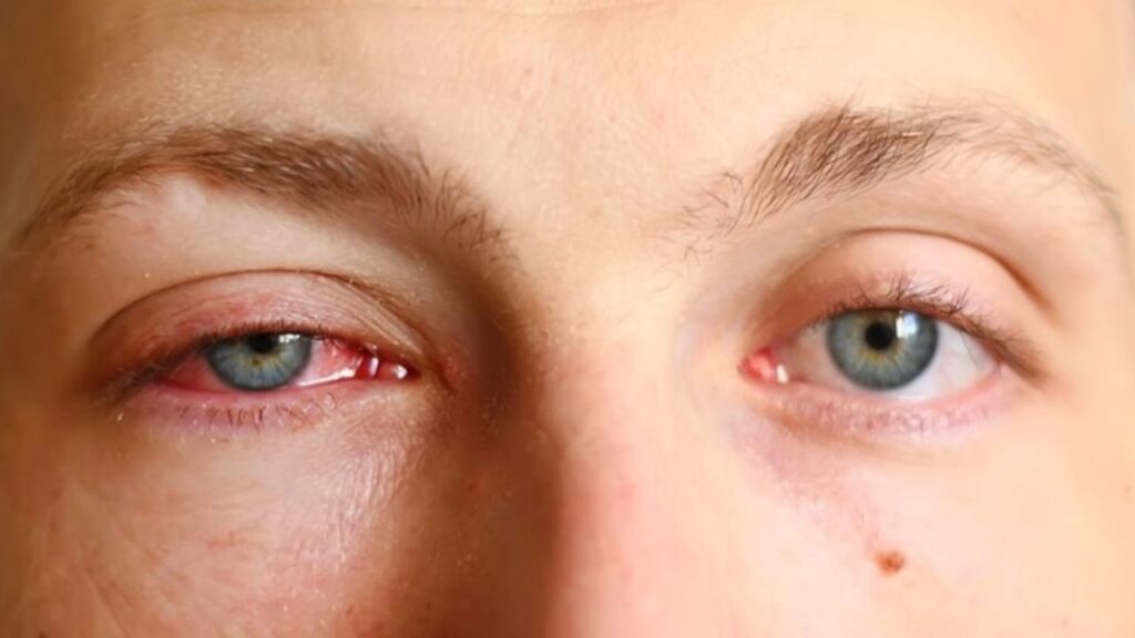 Pink eye
