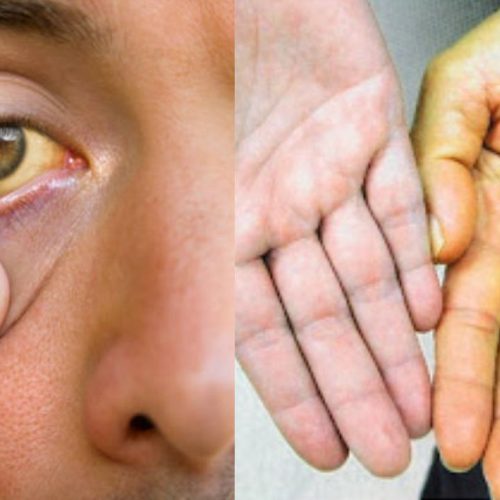 மஞ்சள் காமாலை நோய்