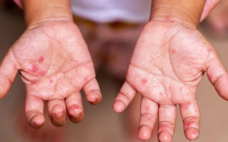 prevention of hand and foot infections