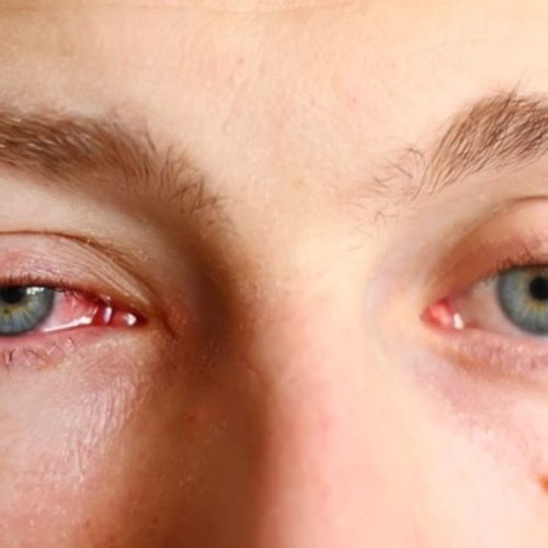 பிங்க் பாதிப்பு
