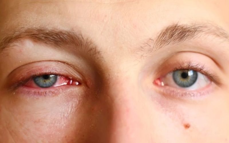 Pink eye